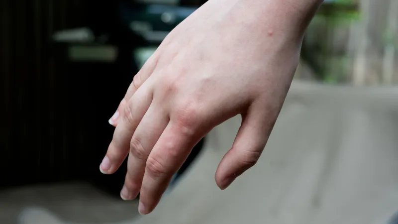 Your skin chemistry may affect which mosquitoes most want to bite you 