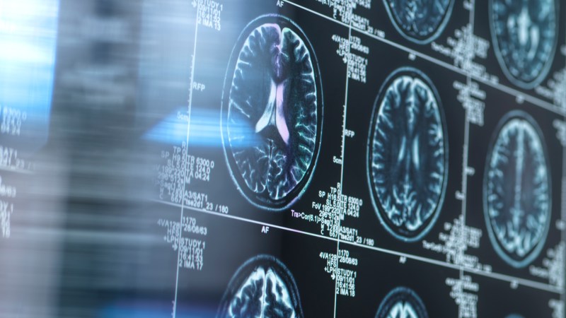 MRIs show brain changes linked to Alzheimer’s years in advance