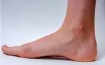 یک راهکار مناسب برای پیشگیری از واریس