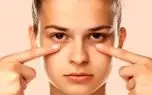 چند راهکار فوری برای رفع پف زیر چشم